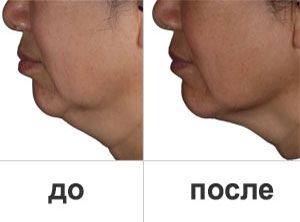 Восстановление овала лица и устранение двойного подбородка «Слим-Фейс-Лифт» Ericson Laboratoire 3