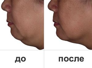Восстановление овала лица и устранение двойного подбородка «Слим-Фейс-Лифт» Ericson Laboratoire 2