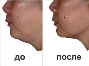 Восстановление овала лица и устранение двойного подбородка «Слим-Фейс-Лифт» Ericson Laboratoire 1